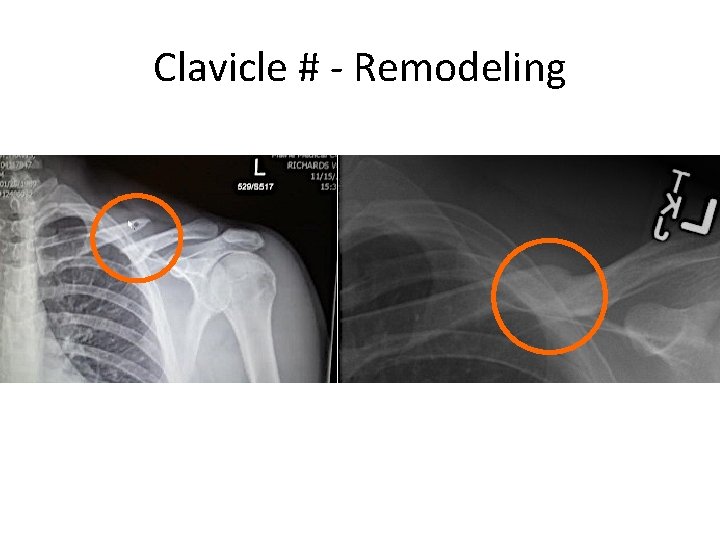 Clavicle # - Remodeling 