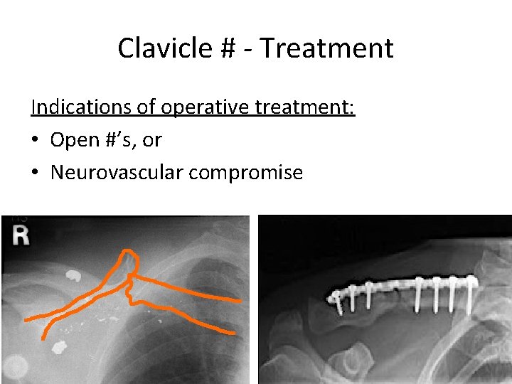 Clavicle # - Treatment Indications of operative treatment: • Open #’s, or • Neurovascular