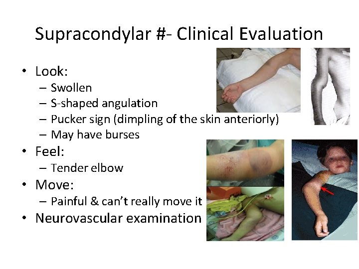 Supracondylar #- Clinical Evaluation • Look: – Swollen – S-shaped angulation – Pucker sign