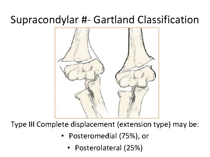 Supracondylar #- Gartland Classification Type III Complete displacement (extension type) may be: • Posteromedial