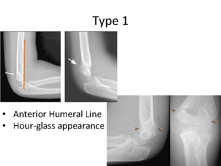 Type 1 • Anterior Humeral Line • Hour-glass appearance 