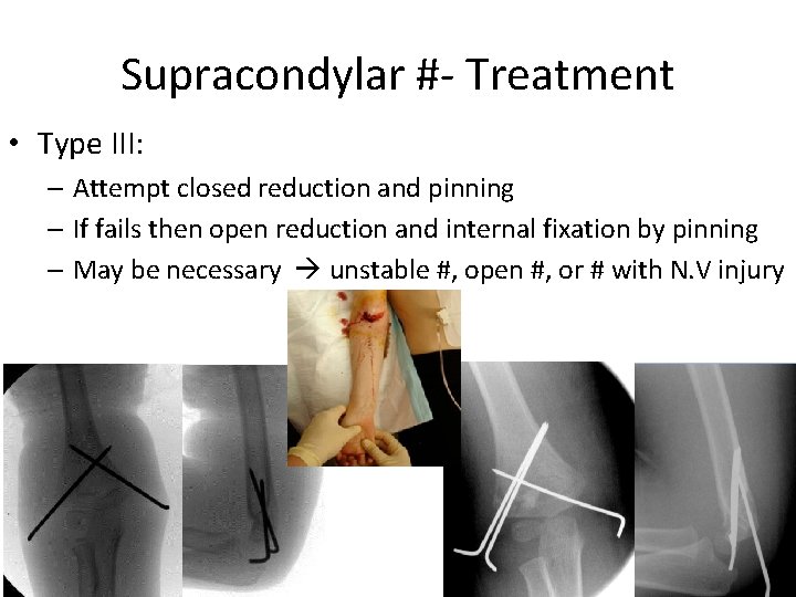 Supracondylar #- Treatment • Type III: – Attempt closed reduction and pinning – If