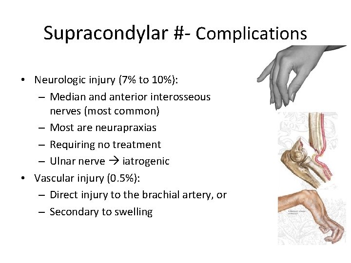 Supracondylar #- Complications • Neurologic injury (7% to 10%): – Median and anterior interosseous