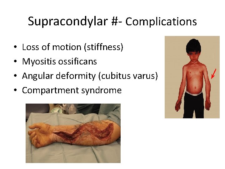 Supracondylar #- Complications • • Loss of motion (stiffness) Myositis ossificans Angular deformity (cubitus