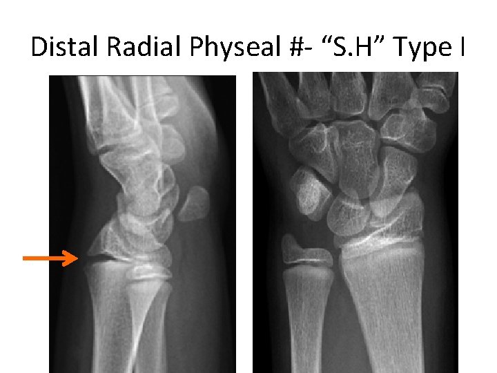 Distal Radial Physeal #- “S. H” Type I 