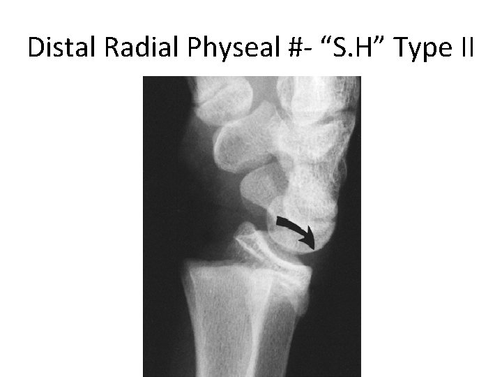 Distal Radial Physeal #- “S. H” Type II 