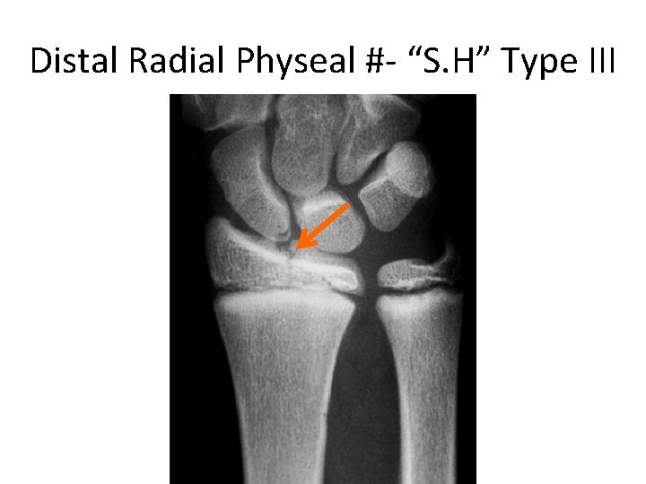 Distal Radial Physeal #- “S. H” Type III 