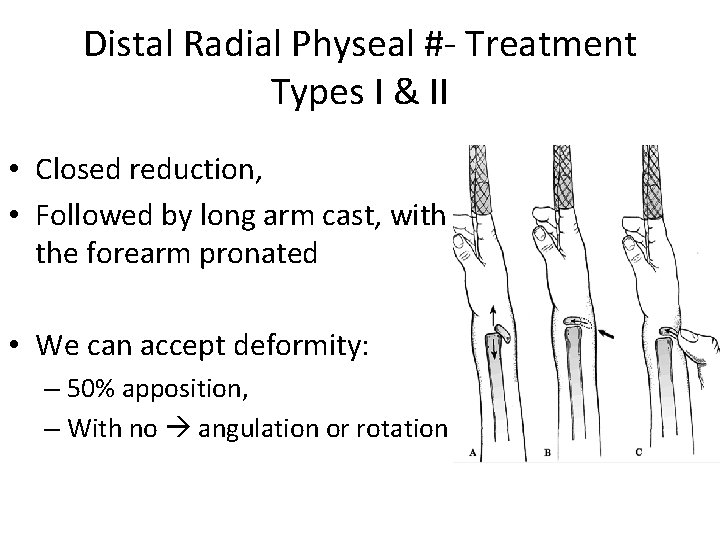 Distal Radial Physeal #- Treatment Types I & II • Closed reduction, • Followed