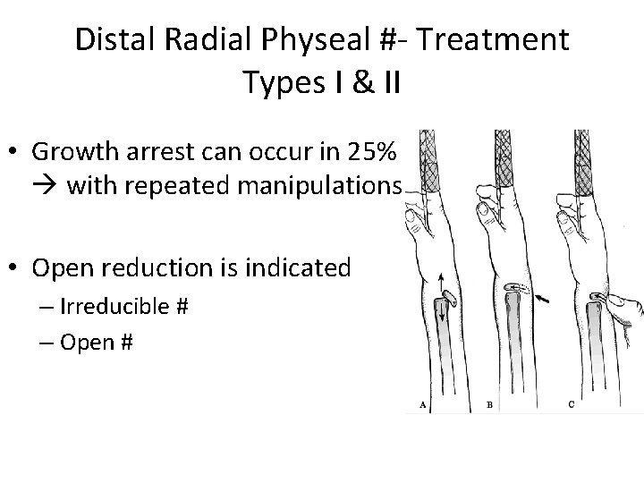 Distal Radial Physeal #- Treatment Types I & II • Growth arrest can occur
