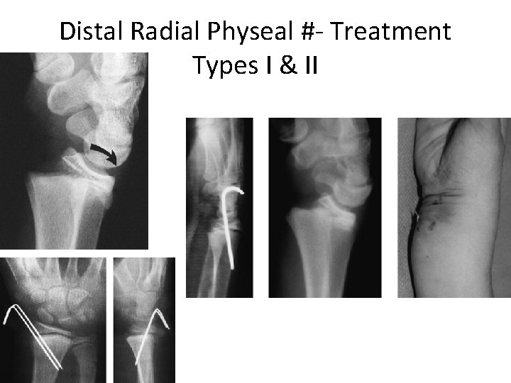 Distal Radial Physeal #- Treatment Types I & II 