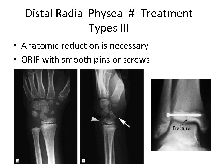 Distal Radial Physeal #- Treatment Types III • Anatomic reduction is necessary • ORIF