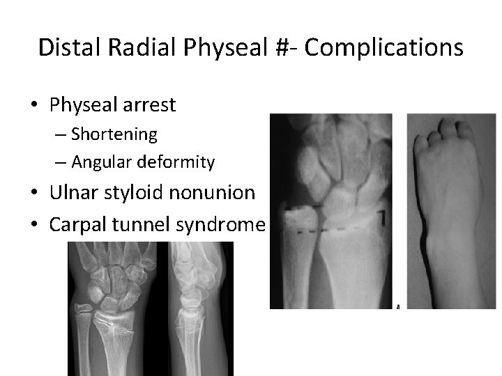 Distal Radial Physeal #- Complications • Physeal arrest – Shortening – Angular deformity •