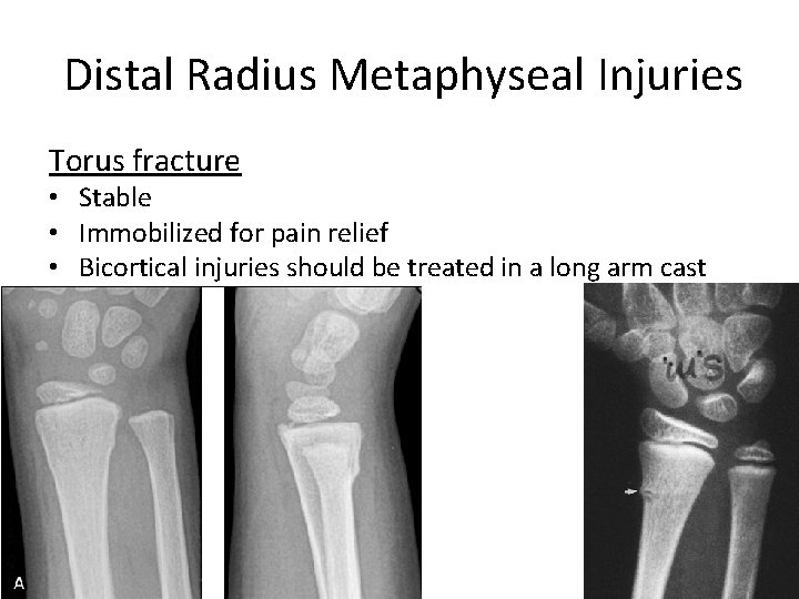 Distal Radius Metaphyseal Injuries Torus fracture • Stable • Immobilized for pain relief •