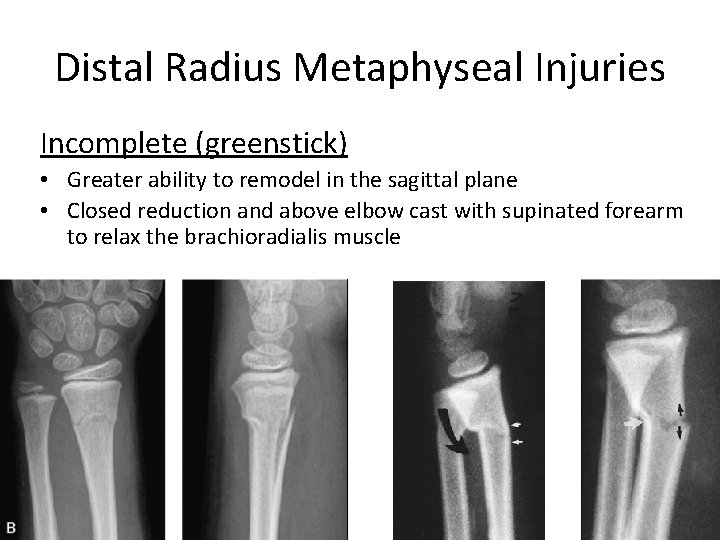 Distal Radius Metaphyseal Injuries Incomplete (greenstick) • Greater ability to remodel in the sagittal