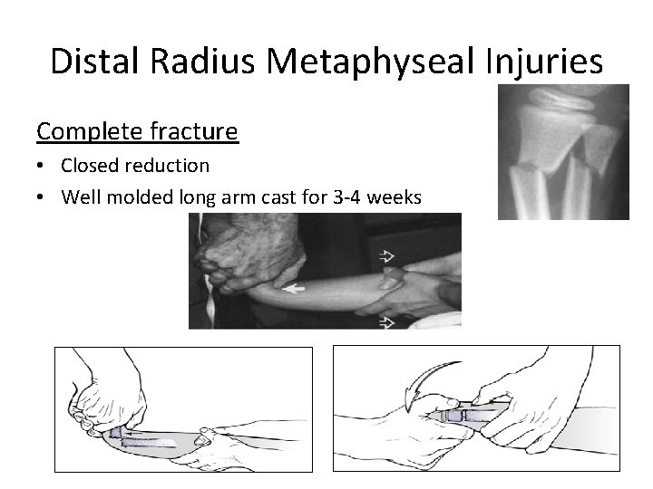 Distal Radius Metaphyseal Injuries Complete fracture • Closed reduction • Well molded long arm