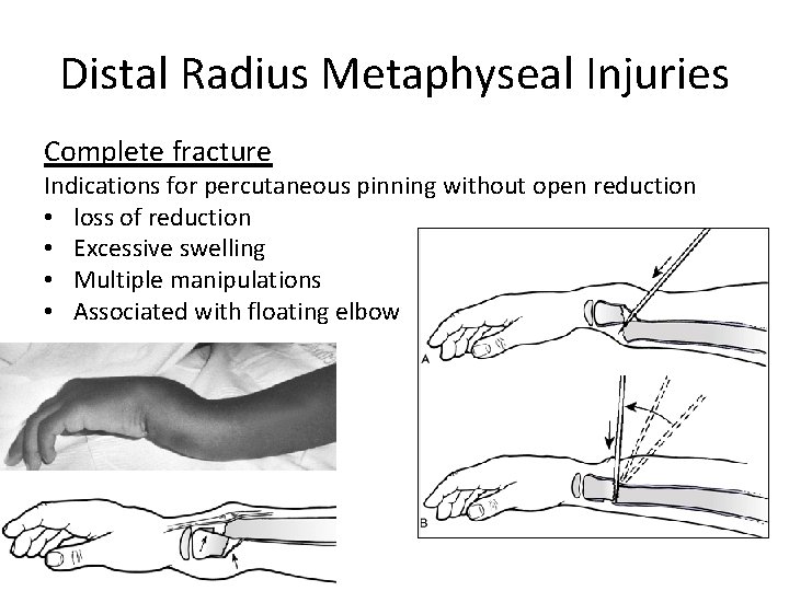 Distal Radius Metaphyseal Injuries Complete fracture Indications for percutaneous pinning without open reduction •