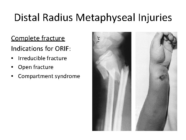 Distal Radius Metaphyseal Injuries Complete fracture Indications for ORIF: • Irreducible fracture • Open