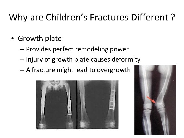 Why are Children’s Fractures Different ? • Growth plate: – Provides perfect remodeling power