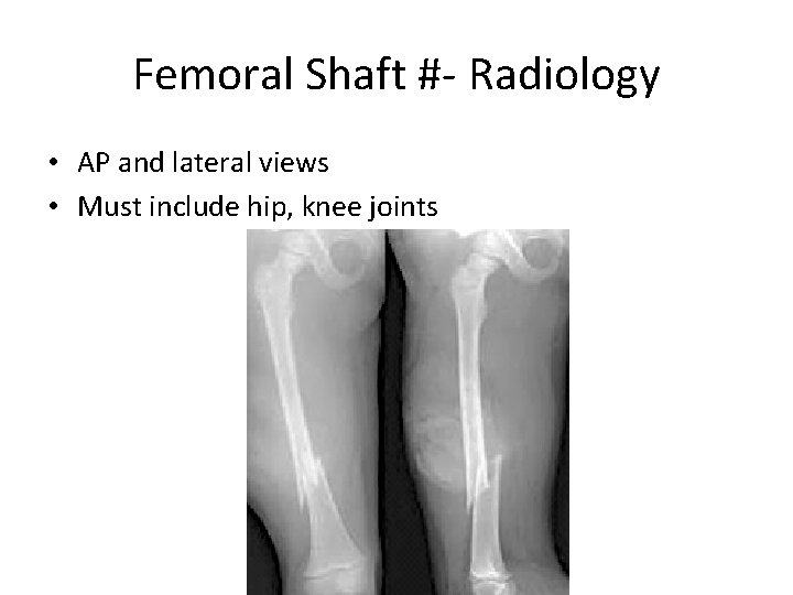 Femoral Shaft #- Radiology • AP and lateral views • Must include hip, knee