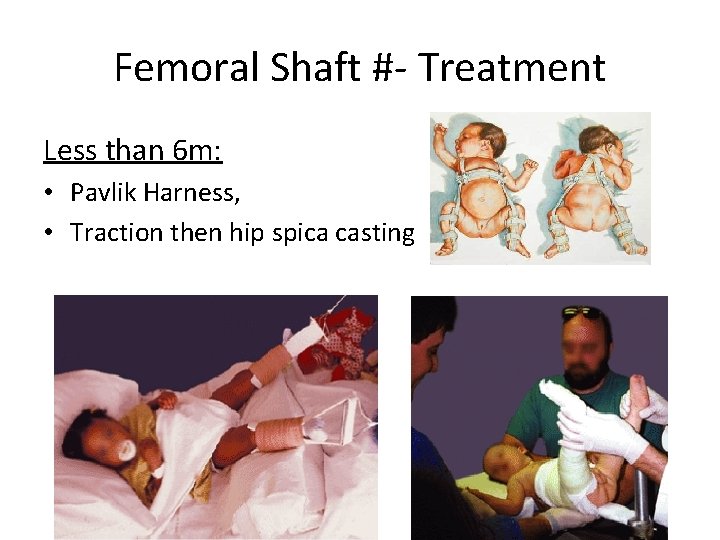 Femoral Shaft #- Treatment Less than 6 m: • Pavlik Harness, • Traction then