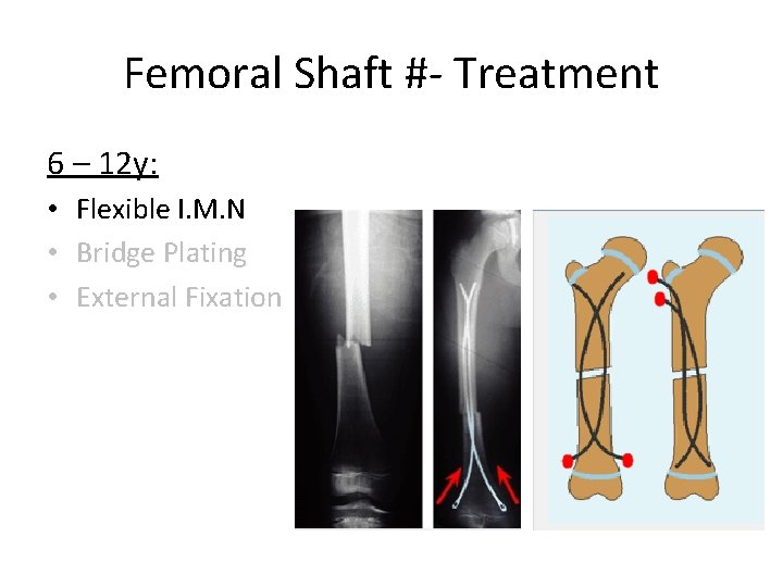 Femoral Shaft #- Treatment 6 – 12 y: • Flexible I. M. N •