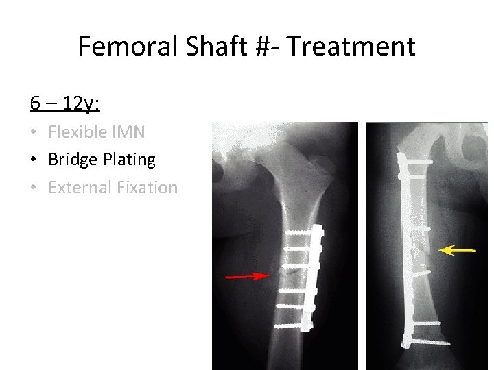 Femoral Shaft #- Treatment 6 – 12 y: • Flexible IMN • Bridge Plating