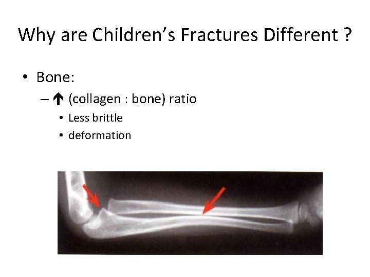 Why are Children’s Fractures Different ? • Bone: – (collagen : bone) ratio •