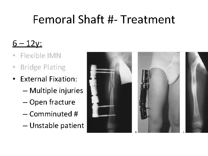 Femoral Shaft #- Treatment 6 – 12 y: • Flexible IMN • Bridge Plating