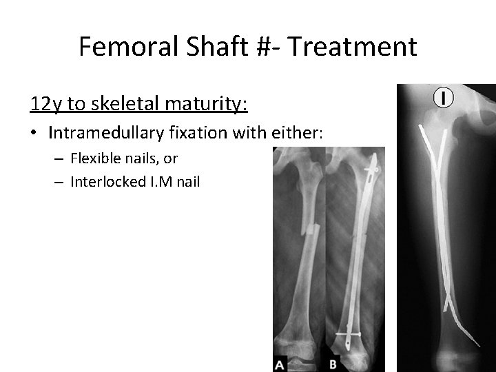 Femoral Shaft #- Treatment 12 y to skeletal maturity: • Intramedullary fixation with either: