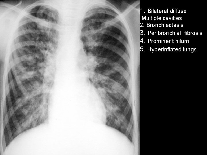 1. Bilateral diffuse Multiple cavities 2. Bronchiectasis 3. Peribronchial fibrosis 4. Prominent hilum 5.