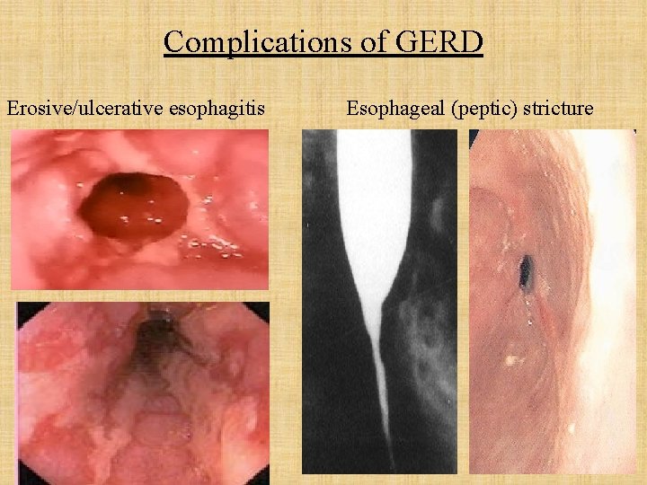 Complications of GERD Erosive/ulcerative esophagitis Esophageal (peptic) stricture 