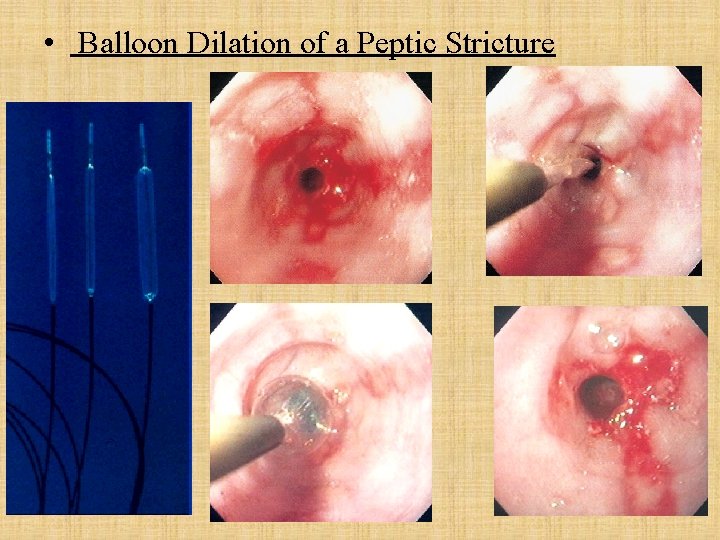  • Balloon Dilation of a Peptic Stricture 