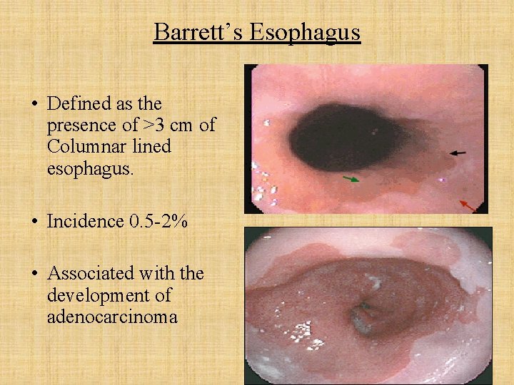 Barrett’s Esophagus • Defined as the presence of >3 cm of Columnar lined esophagus.