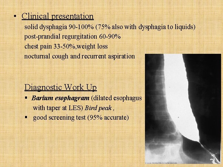  • Clinical presentation solid dysphagia 90 -100% (75% also with dysphagia to liquids)