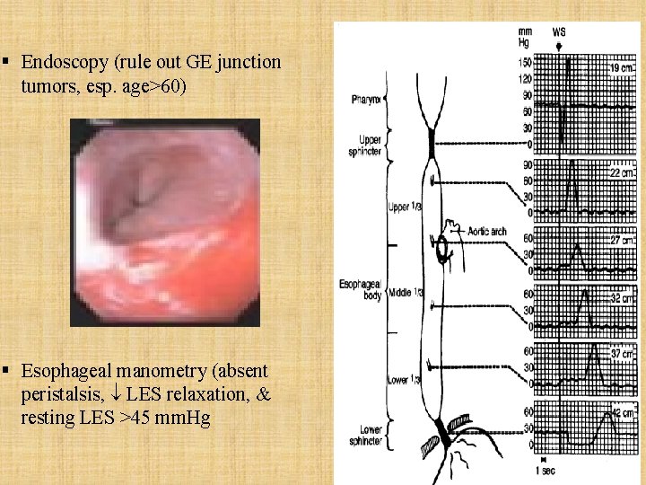 § Endoscopy (rule out GE junction tumors, esp. age>60) § Esophageal manometry (absent peristalsis,