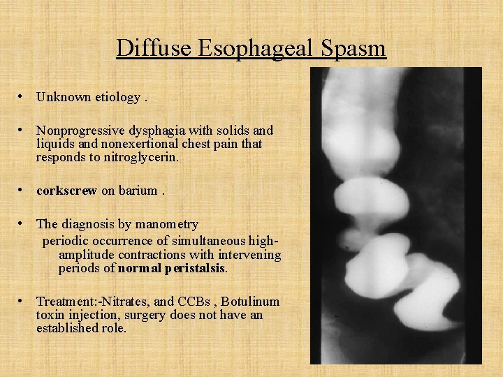 Diffuse Esophageal Spasm • Unknown etiology. • Nonprogressive dysphagia with solids and liquids and