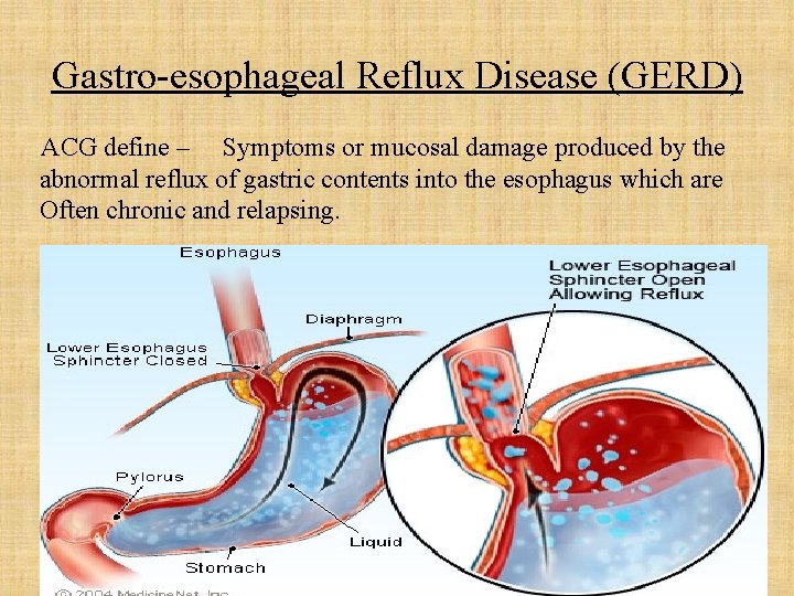 Gastro-esophageal Reflux Disease (GERD) ACG define – Symptoms or mucosal damage produced by the