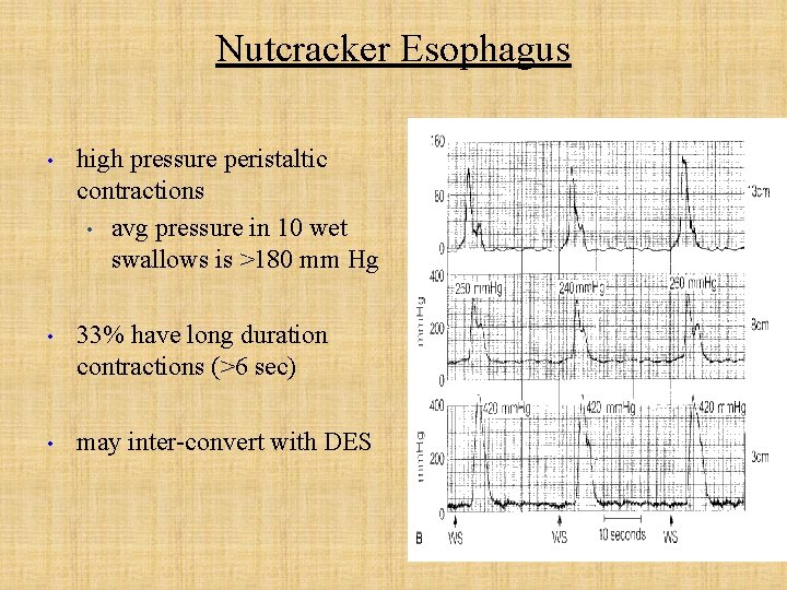 Nutcracker Esophagus • high pressure peristaltic contractions • avg pressure in 10 wet swallows