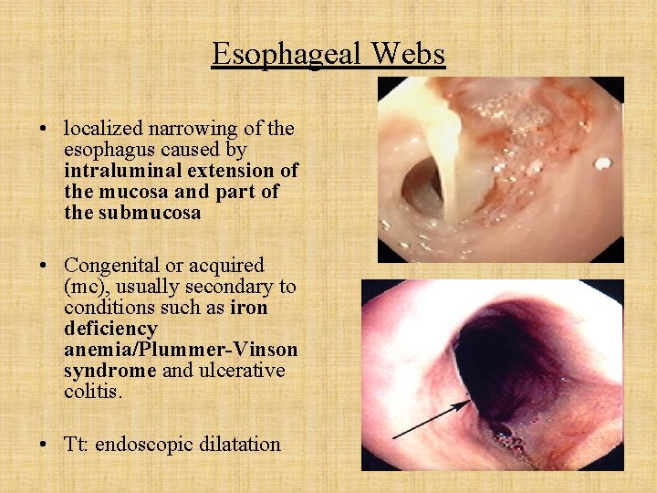 Esophageal Webs • localized narrowing of the esophagus caused by intraluminal extension of the