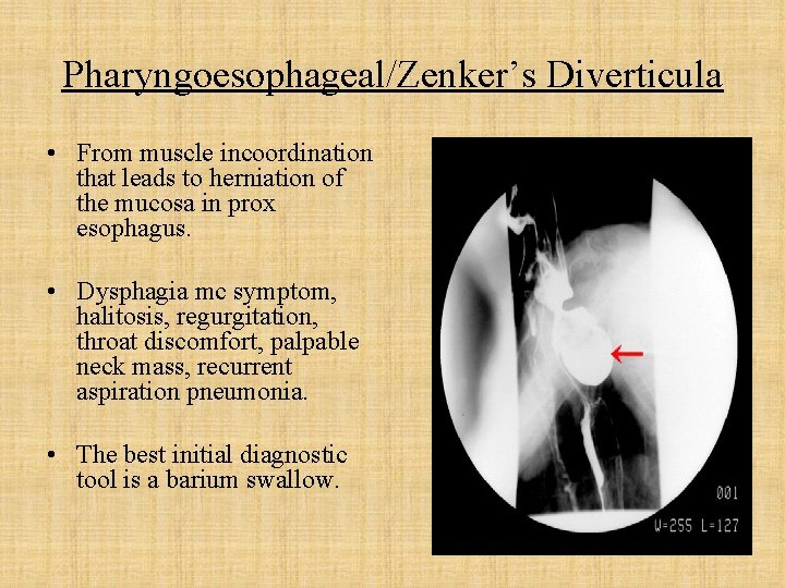 Pharyngoesophageal/Zenker’s Diverticula • From muscle incoordination that leads to herniation of the mucosa in