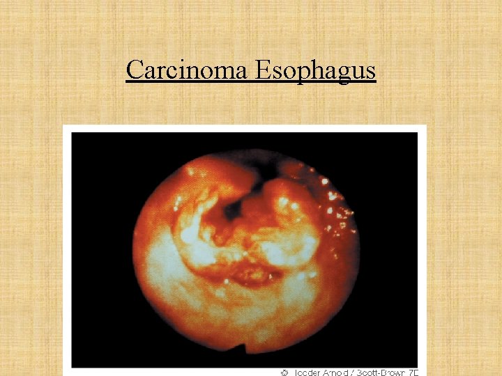 Carcinoma Esophagus 