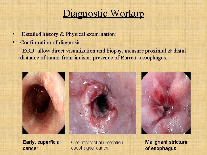 Diagnostic Workup • Detailed history & Physical examination: • Confirmation of diagnosis: EGD: allow