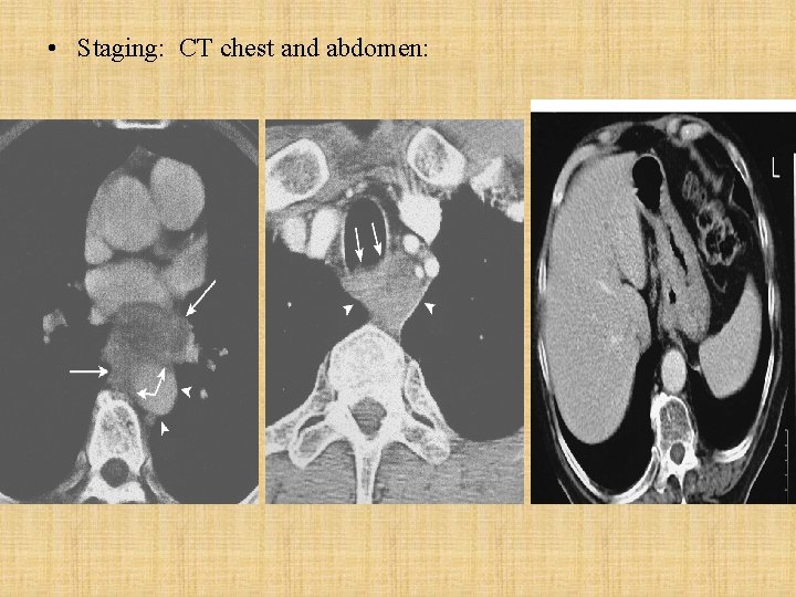  • Staging: CT chest and abdomen: 