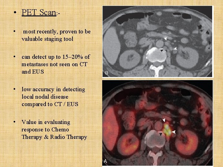  • PET Scan: • most recently, proven to be valuable staging tool •