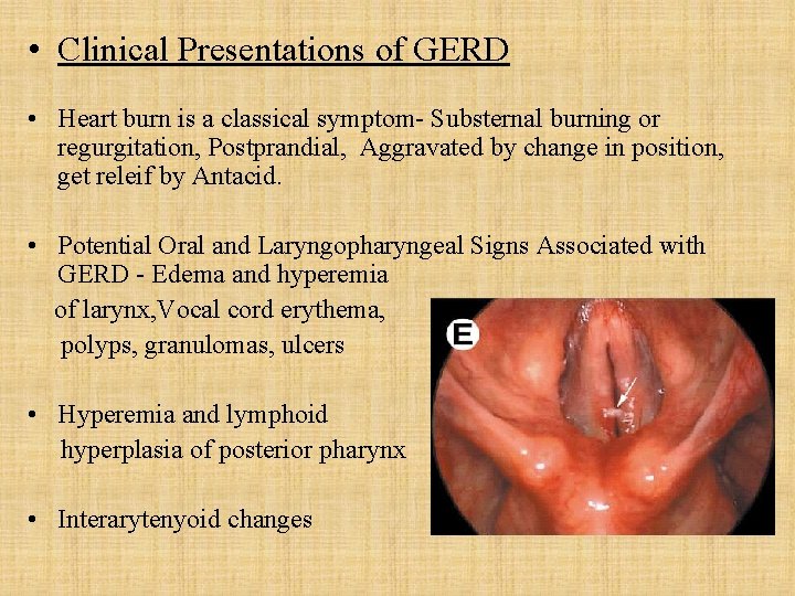  • Clinical Presentations of GERD • Heart burn is a classical symptom- Substernal