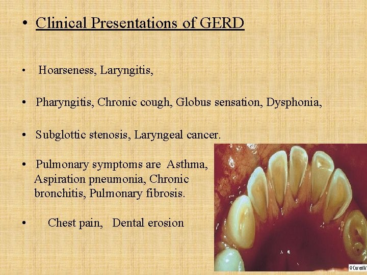  • Clinical Presentations of GERD • Hoarseness, Laryngitis, • Pharyngitis, Chronic cough, Globus