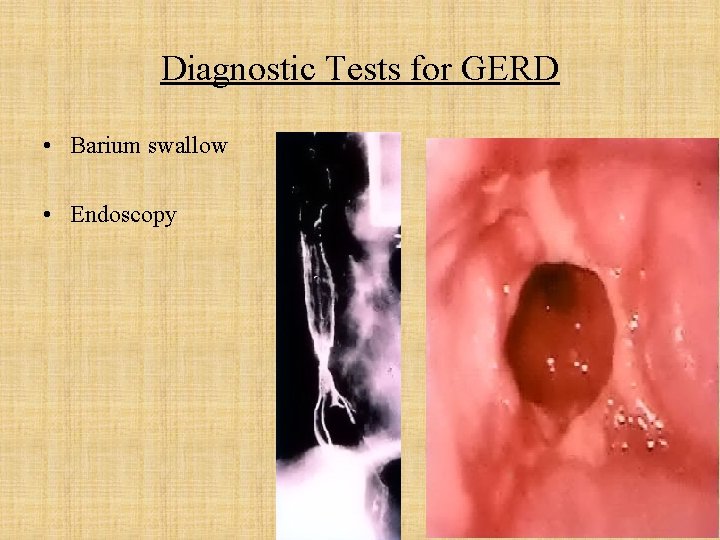 Diagnostic Tests for GERD • Barium swallow • Endoscopy 