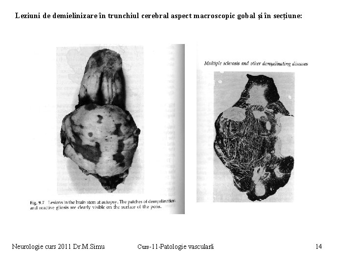 Leziuni de demielinizare în trunchiul cerebral aspect macroscopic gobal şi în secţiune: Neurologie curs