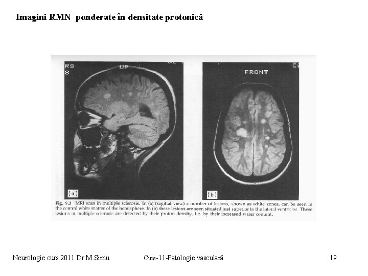 Imagini RMN ponderate în densitate protonică Neurologie curs 2011 Dr. M. Simu Curs-11 -Patologie