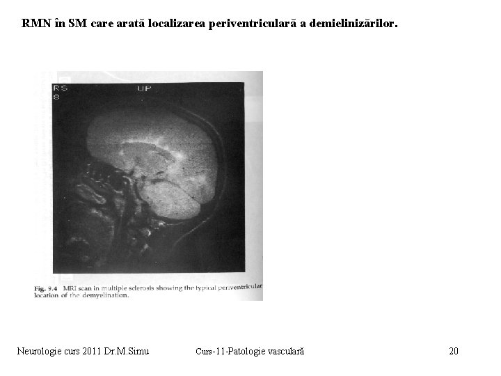 RMN în SM care arată localizarea periventriculară a demielinizărilor. Neurologie curs 2011 Dr. M.